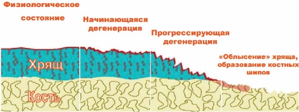 Артроз