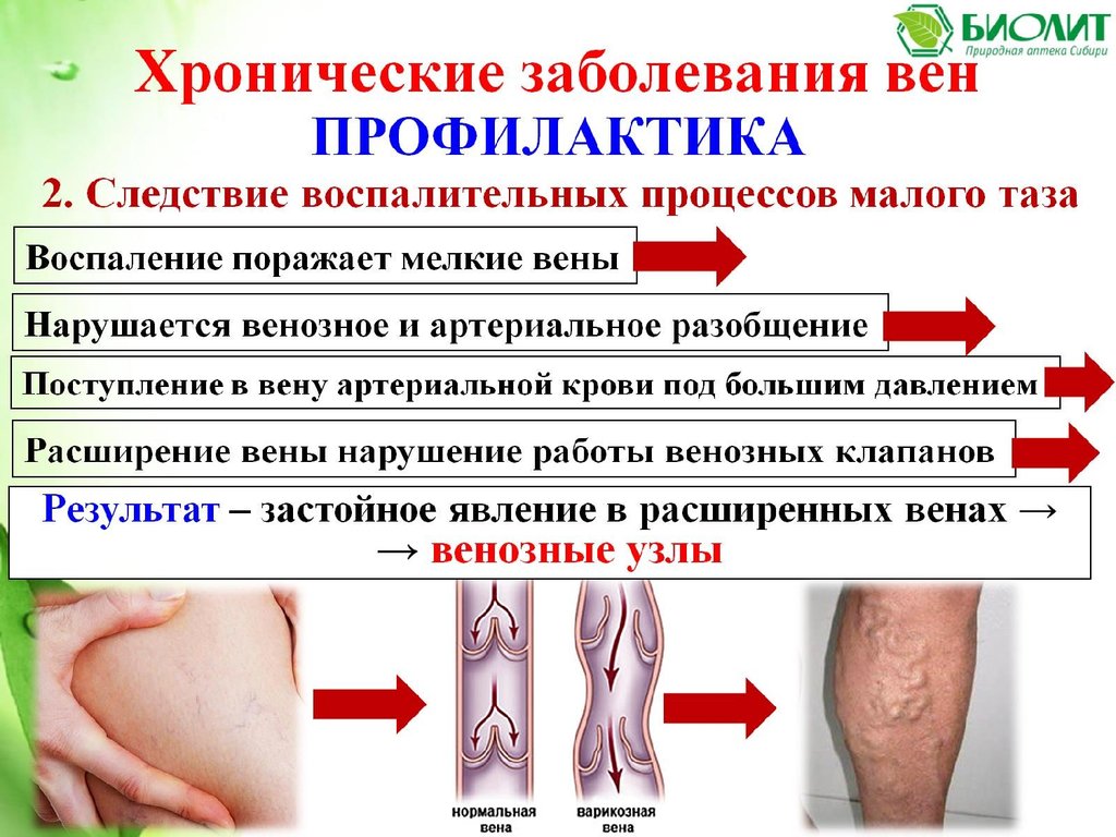 Здоровые вены Арго
