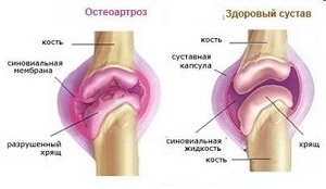 Остеопороз